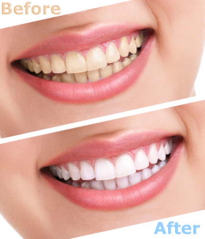 Affordable Teeth Whitening Dentist Price in Kumbakonam – Nalamm Dental Cosmetiks