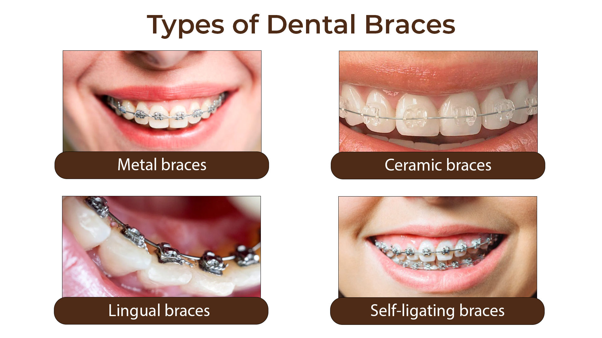 Average Price for Braces in Kumbakonam – Nalamm Dental Cosmetiks