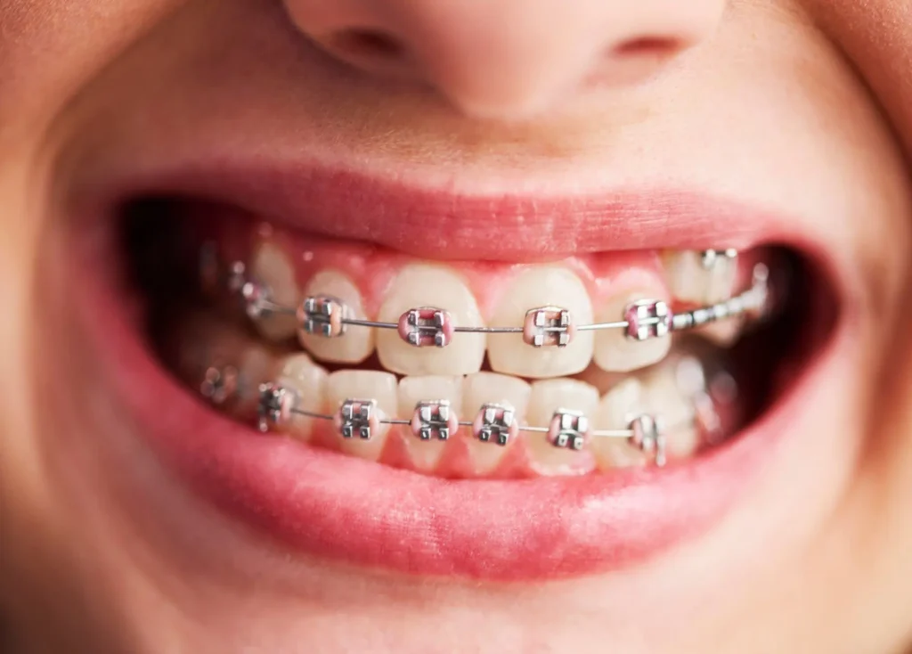 Average Price for Braces in Kumbakonam – Nalamm Dental Cosmetiks