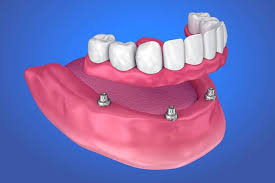 Best Dental Implants and Dentures Treatments in Kumbakonam – Nalamm Dental Cosmetiks
