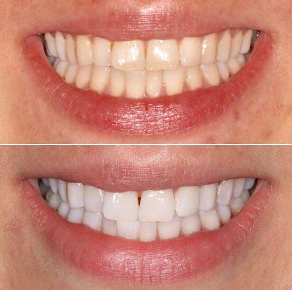 Best Fluorosis Teeth Whitening Treatments in Kumbakonam – Nalamm Dental Cosmetiks