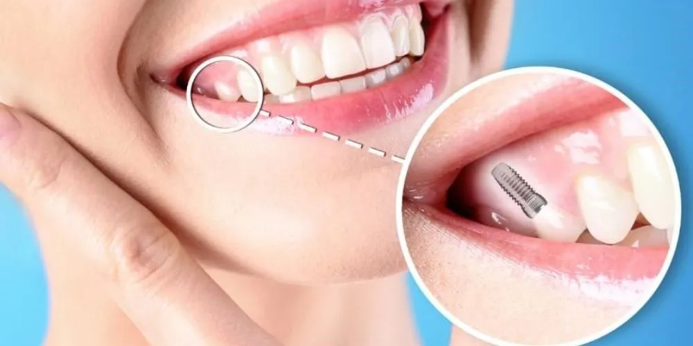Best Implantologist Near Me in Kumbakonam – Nalamm Dental Cosmetiks