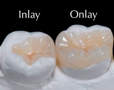 Best Inlay Onlay Treatments in Kumbakonam – Nalamm Dental Cosmetiks