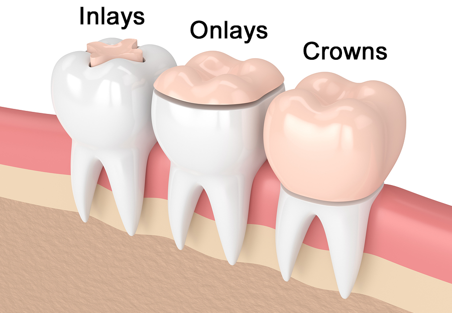 Best Inlay Onlay Treatments in Kumbakonam – Nalamm Dental Cosmetiks