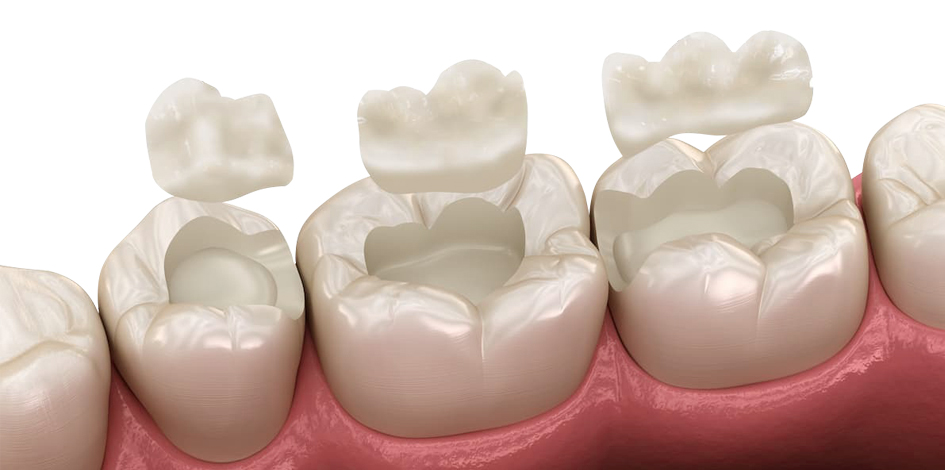 Best Inlay Onlay Treatments in Kumbakonam – Nalamm Dental Cosmetiks