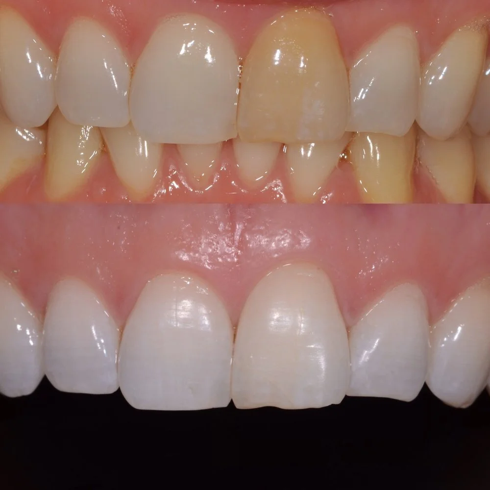 Best Internal Bleaching Tooth Treatments in Kumbakonam – Nalamm Dental Cosmetiks