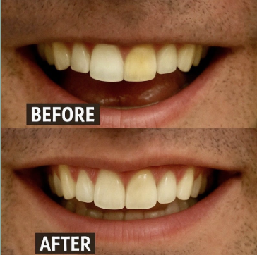 Best Internal Bleaching Tooth Treatments in Kumbakonam – Nalamm Dental Cosmetiks