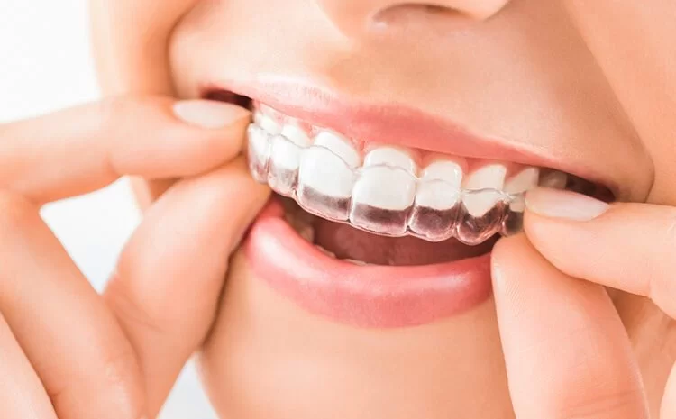 Best Invisible Dental Braces Treatments in Kumbakonam – Nalamm Dental Cosmetiks
