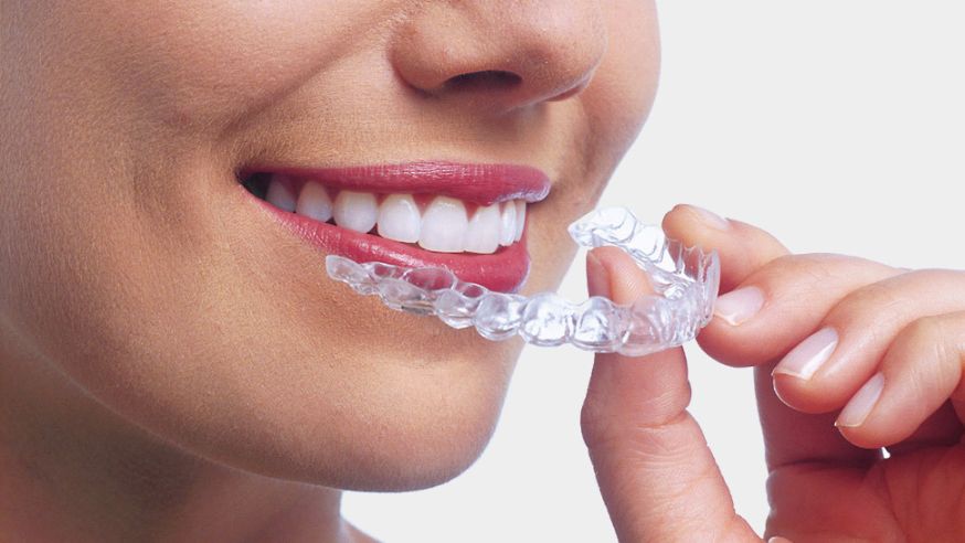 Best Invisible Dental Braces Treatments in Kumbakonam – Nalamm Dental Cosmetiks