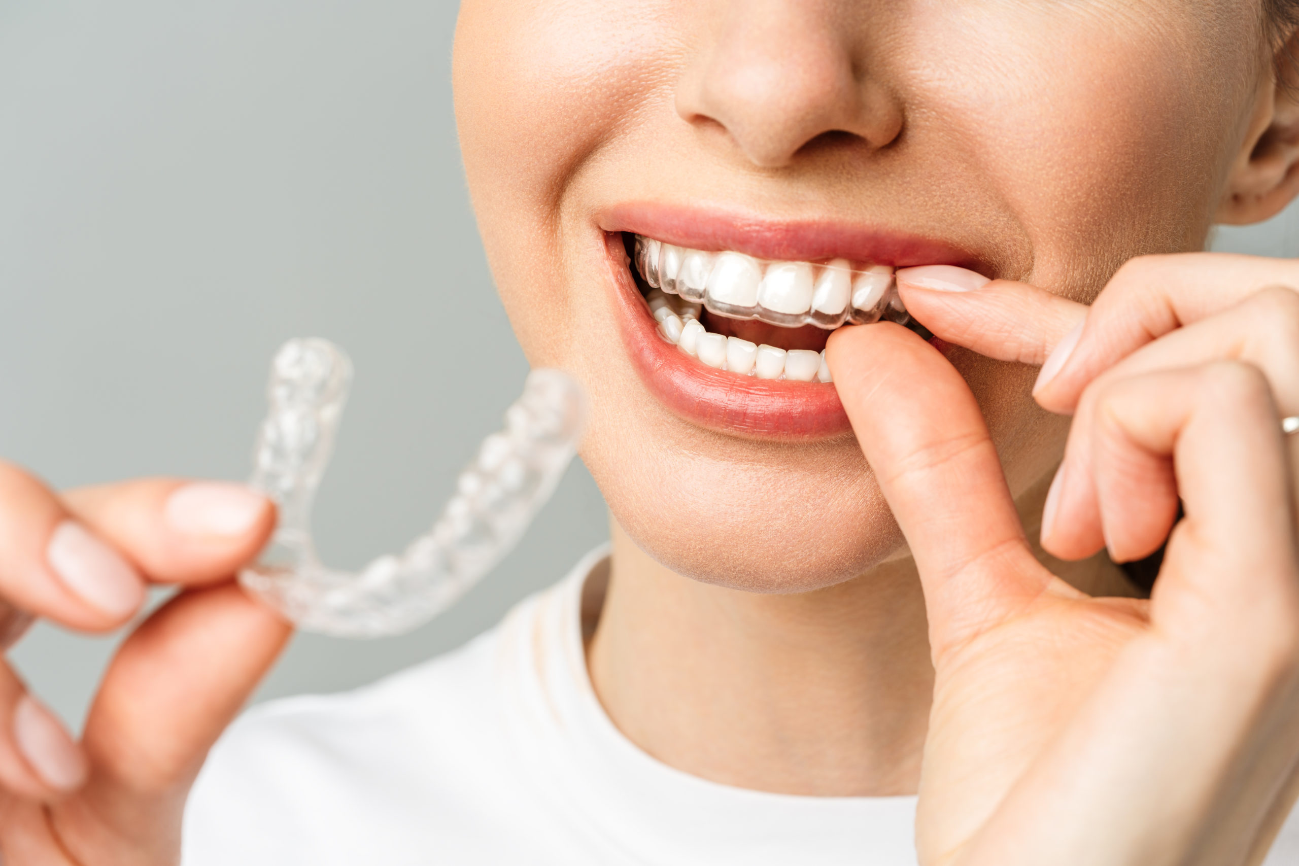 Best Invisible Line Teeth Treatments in Kumbakonam – Nalamm Dental Cosmetiks