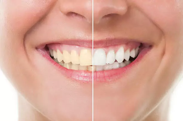Best Veneer Whitening Treatments in Kumbakonam – Nalamm Dental Cosmetiks