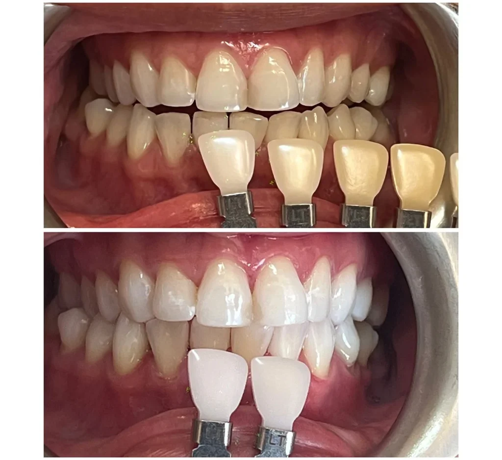 Best Yellow Stained Teeth Cleaning Treatment in Kumbakonam – Nalamm Dental Cosmetiks