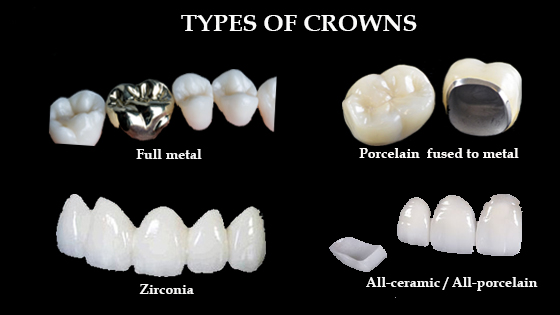 Dental Crown Cost in Kumbakonam – Nalamm Dental Cosmetiks