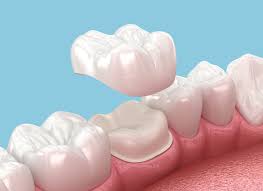 Dental Crown Cost in Kumbakonam – Nalamm Dental Cosmetiks