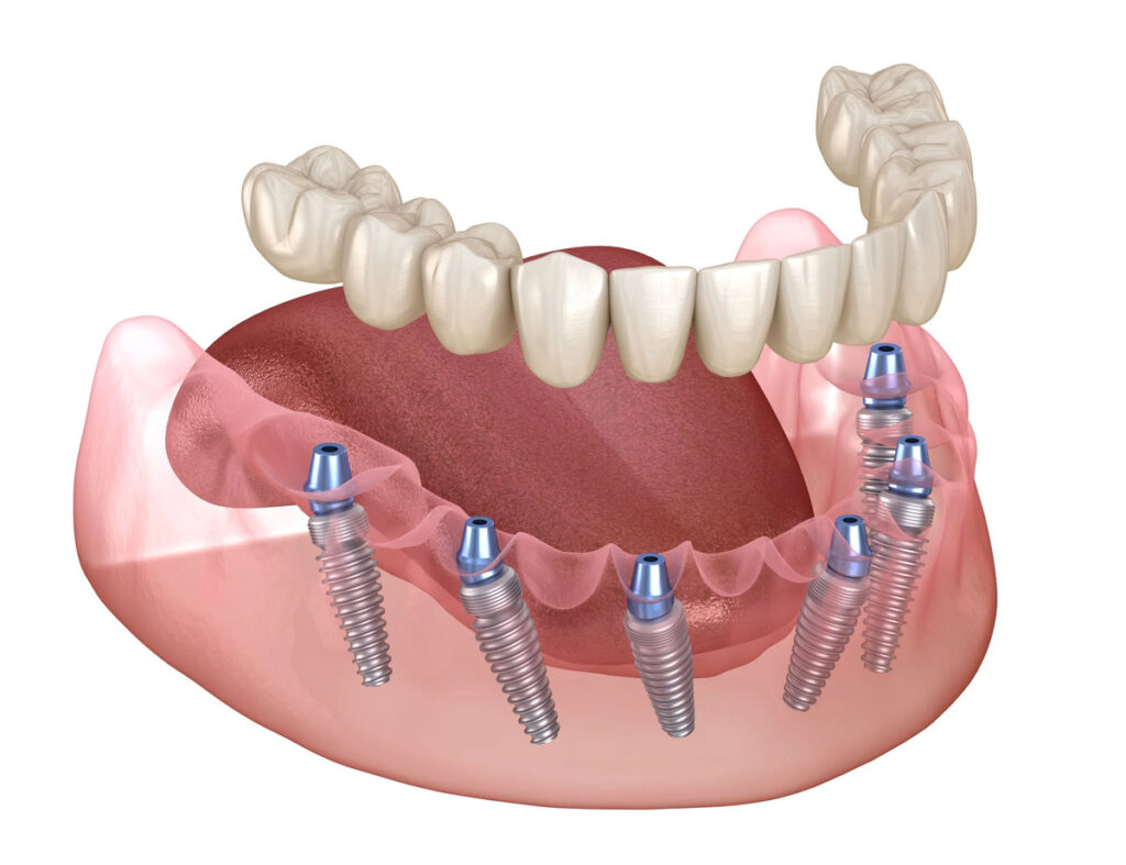 Full Dental Implants Treatments in Kumbakonam – Nalamm Dental Cosmetiks
