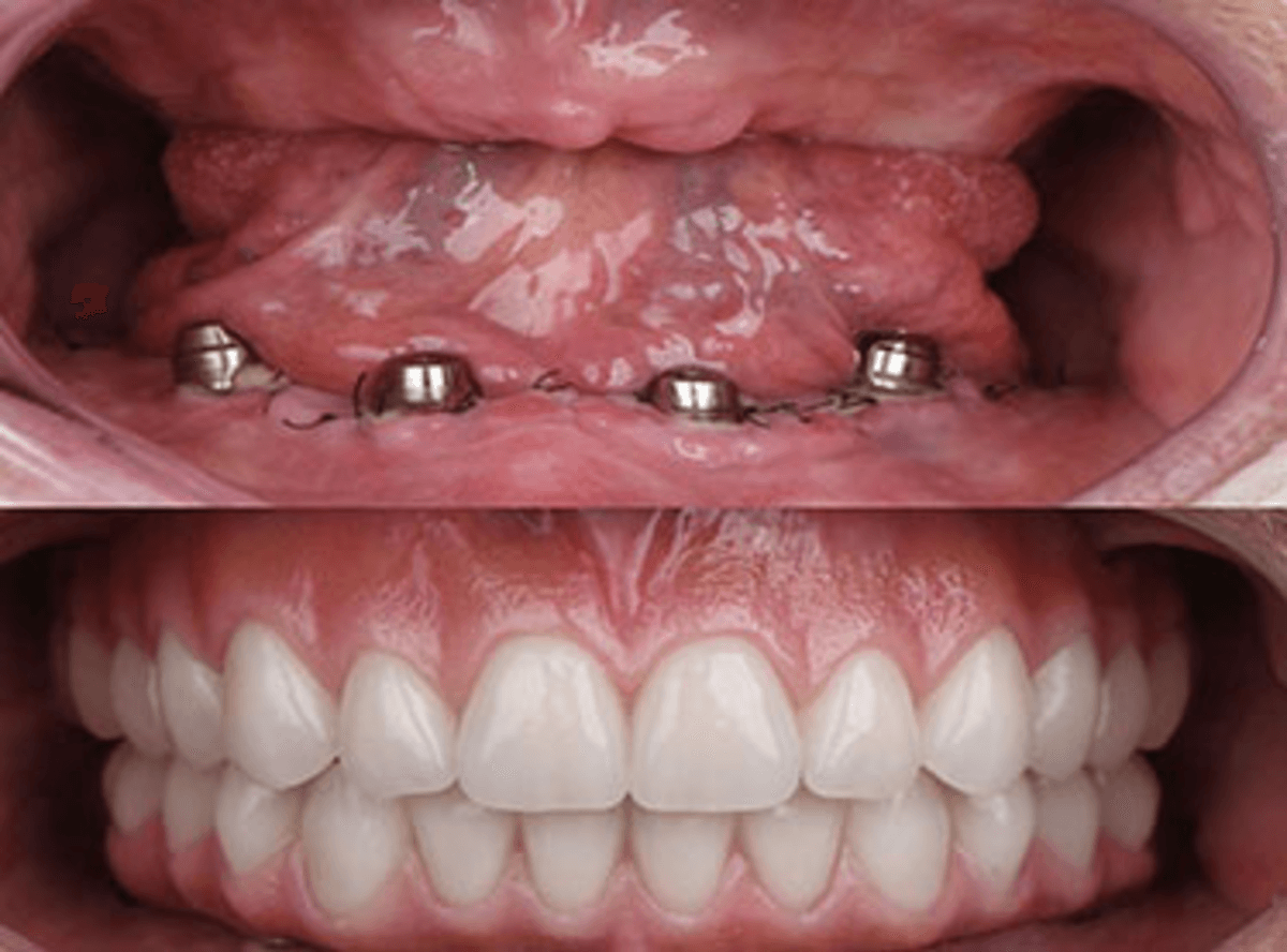 Full Dental Implants Treatments in Kumbakonam – Nalamm Dental Cosmetiks