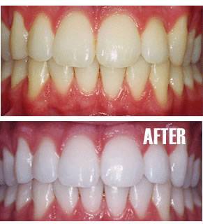 Professional Teeth Bleaching Treatments in Kumbakonam – Nalamm Dental Cosmetiks