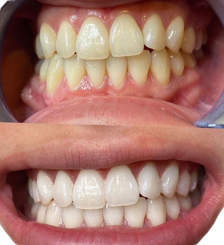 Professional Teeth Bleaching Treatments in Kumbakonam – Nalamm Dental Cosmetiks