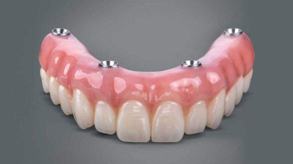 All on 4 Dental Implants Treatments in Kumbakonam – Nalamm Dental Cosmetiks