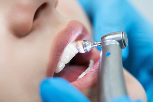Best Teeth Cleaning Treatments in Kumbakonam – Nalamm Dental Cosmetiks