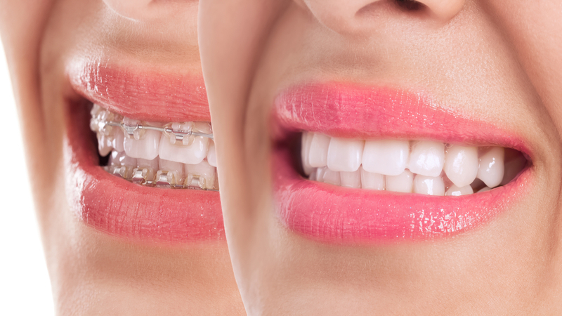 Braces and Smiles Treatments in Kumbakonam – Nalamm Dental Cosmetiks