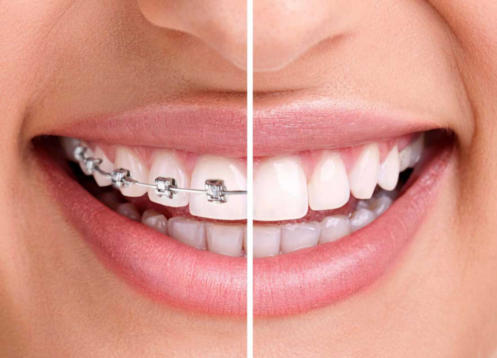 Braces and Smiles Treatments in Kumbakonam – Nalamm Dental Cosmetiks