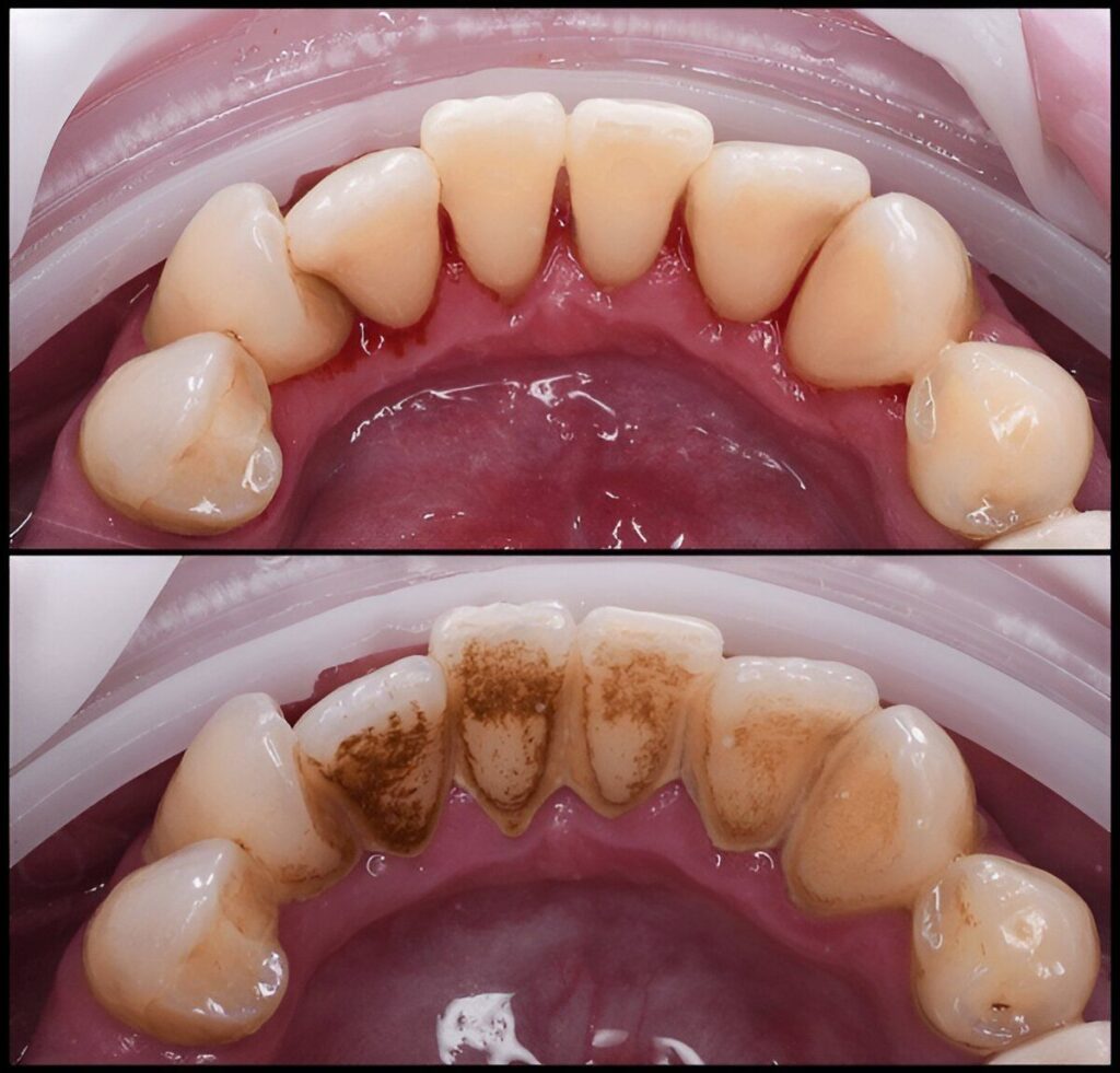 Deep Teeth Cleaning Near Me in Kumbakonam – Nalamm Dental Cosmetiks