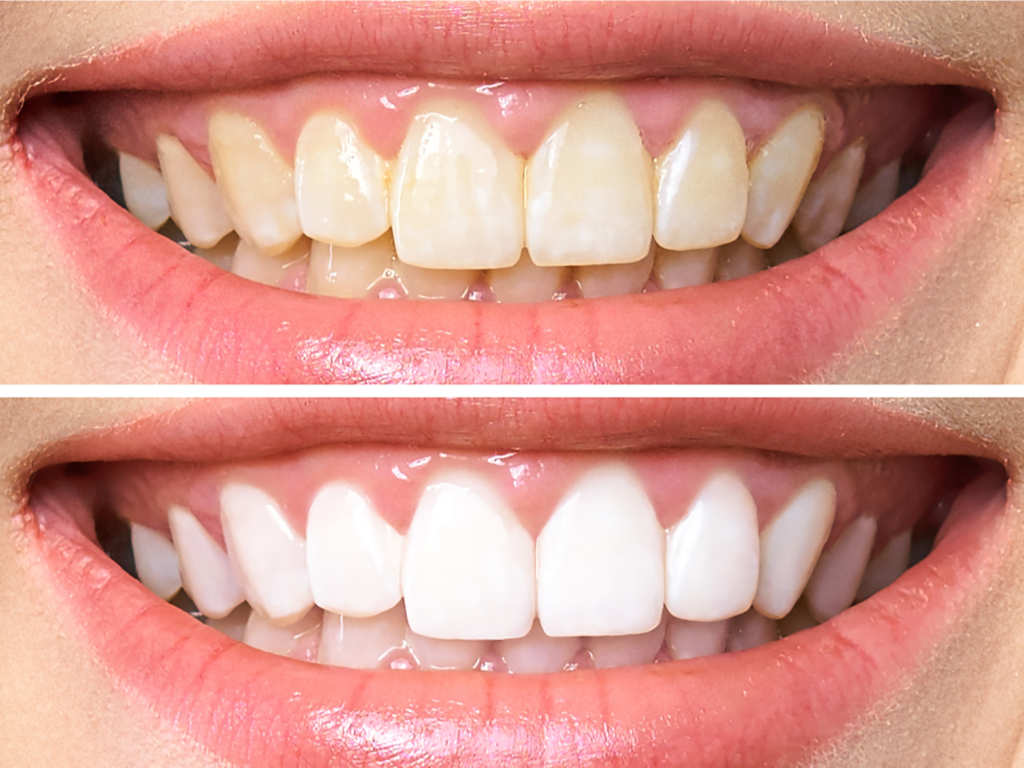 Homemade Teeth Whitening Treatments in Kumbakonam – Nalamm Dental Cosmetiks