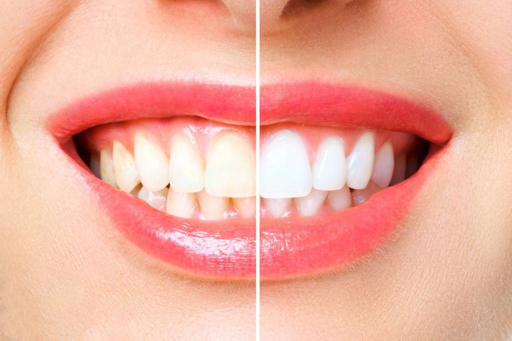Homemade Teeth Whitening Treatments in Kumbakonam – Nalamm Dental Cosmetiks