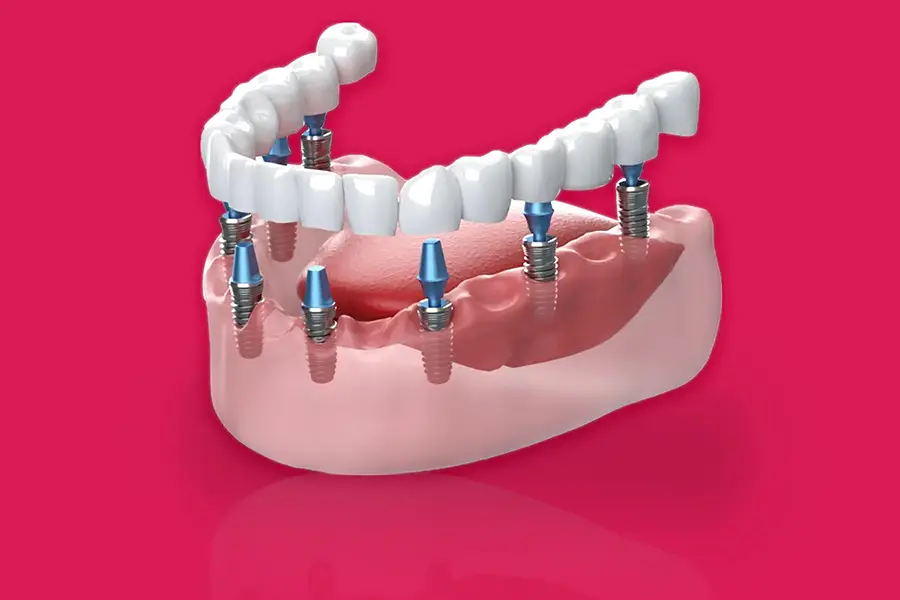 Implants Near Me in Kumbakonam – Nalamm Dental Cosmetiks