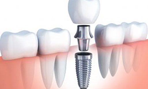 Implants Near Me in Kumbakonam – Nalamm Dental Cosmetiks
