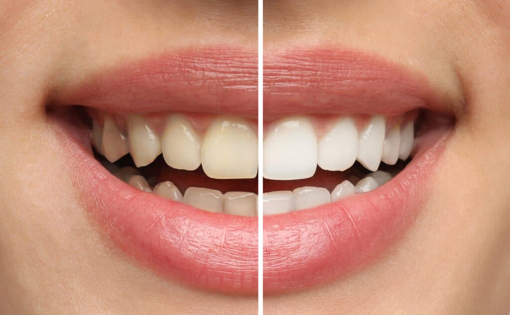 Internal Teeth Whitening Services in Kumbakonam – Nalamm Dental Cosmetiks