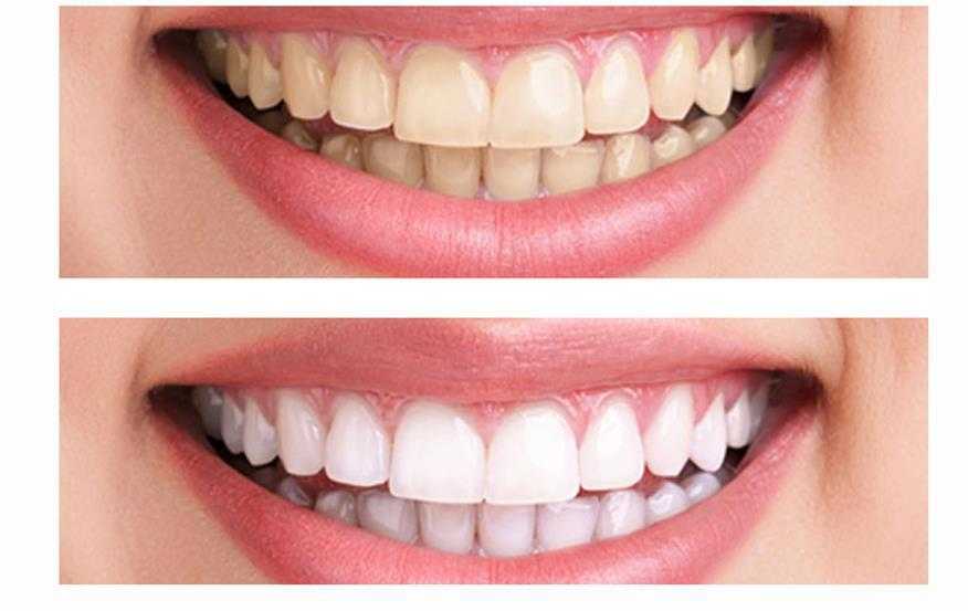 Internal Teeth Whitening Treatments in Kumbakonam – Nalamm Dental Cosmetiks