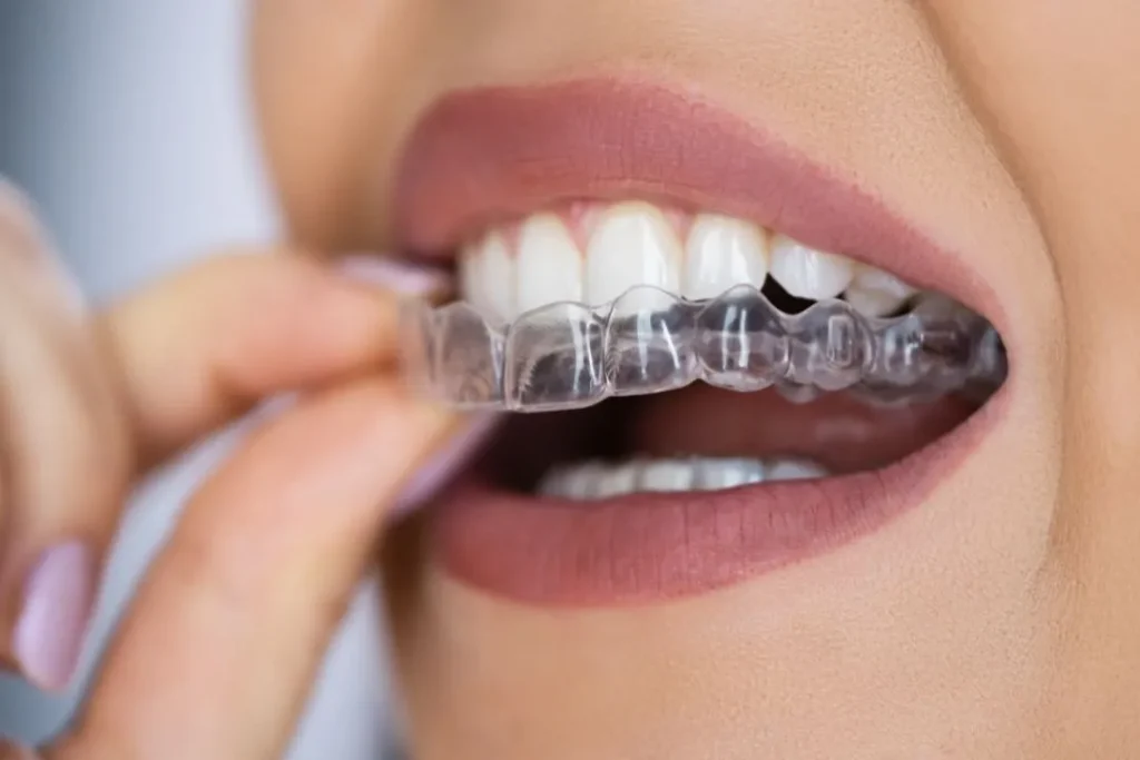 Invisible Teeth Braces Treatments in Kumbakonam – Nalamm Dental Cosmetiks