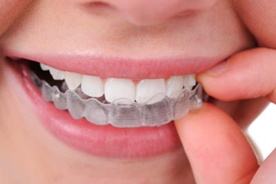 Invisible Teeth Braces Treatments in Kumbakonam – Nalamm Dental Cosmetiks