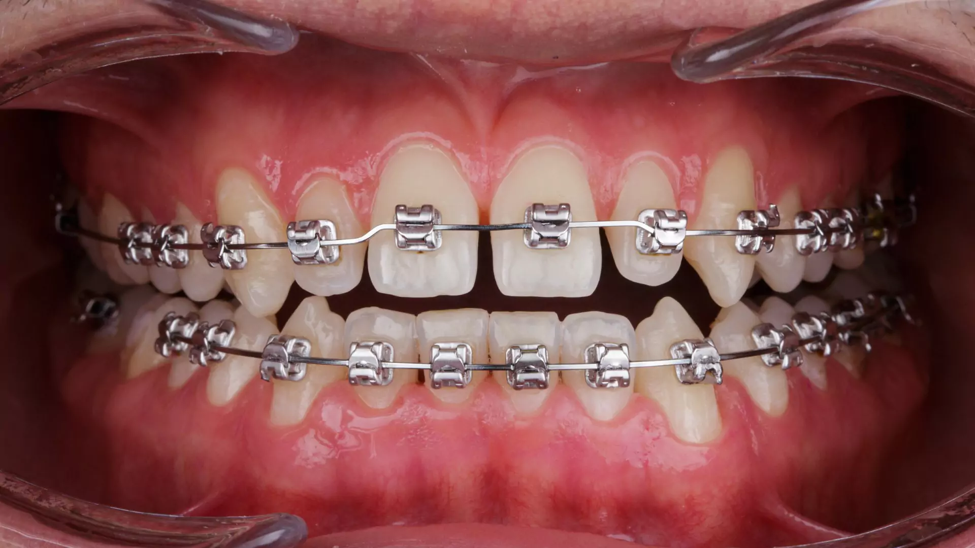 Metal Braces Treatments in Kumbakonam – Nalamm Dental Cosmetiks