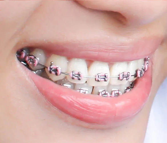 Metal Braces Treatments in Kumbakonam – Nalamm Dental Cosmetiks