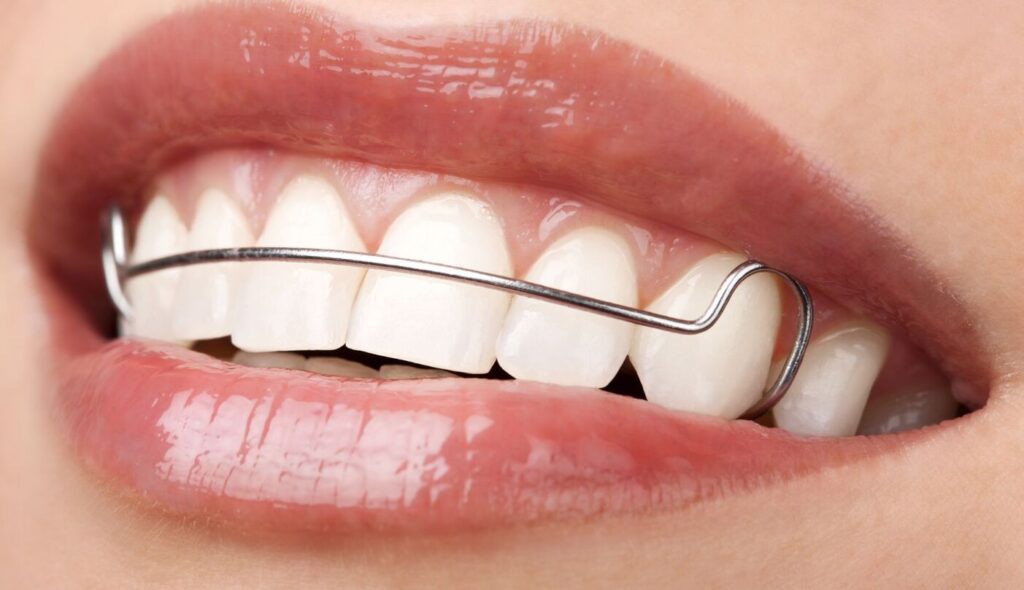 Orthodontic Retainers Treatments in Kumbakonam – Nalamm Dental Cosmetiks