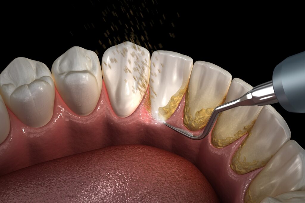 Teeth Cleaning Near Me in Kumbakonam – Nalamm Dental Cosmetiks