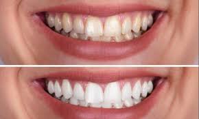 Teeth Whitening Dentist Cost in Kumbakonam – Nalamm Dental Cosmetiks
