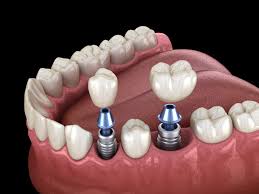 Tooth Transplant Cost in Kumbakonam – Nalamm Dental Cosmetiks