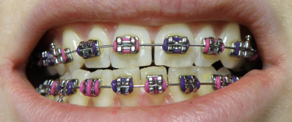 Braces for Teeth Treatments in Kumbakonam – Nalamm Dental Cosmetiks