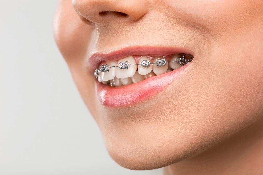 Braces for Teeth Treatments in Kumbakonam – Nalamm Dental Cosmetiks
