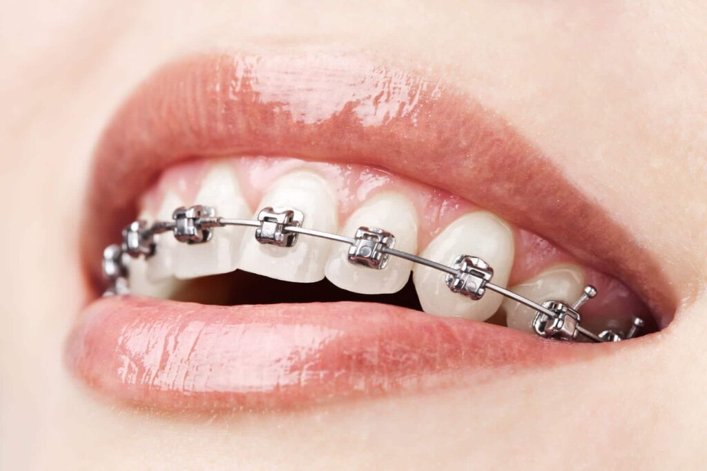Braces for Teeth Treatments in Kumbakonam – Nalamm Dental Cosmetiks
