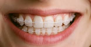 Ceramic Braces Treatment in Kumbakonam – Nalamm Dental Cosmetiks