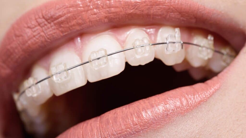 Ceramic Braces Treatment in Kumbakonam – Nalamm Dental Cosmetiks