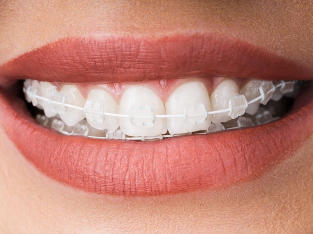 Ceramic Braces Treatment in Kumbakonam – Nalamm Dental Cosmetiks