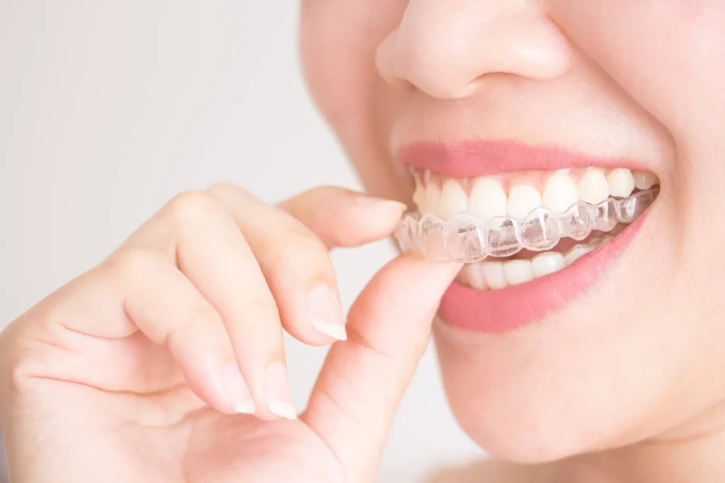 Clear Aligners & Teeth Straightening Treatment in Kumbakonam – Nalamm Dental Cosmetiks