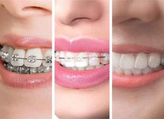 Clear Aligners & Teeth Straightening Treatment in Kumbakonam – Nalamm Dental Cosmetiks
