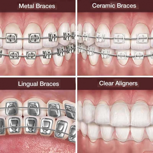 Clear Aligners & Teeth Straightening Treatment in Kumbakonam – Nalamm Dental Cosmetiks